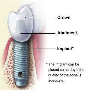 what affects the cost of dental implants