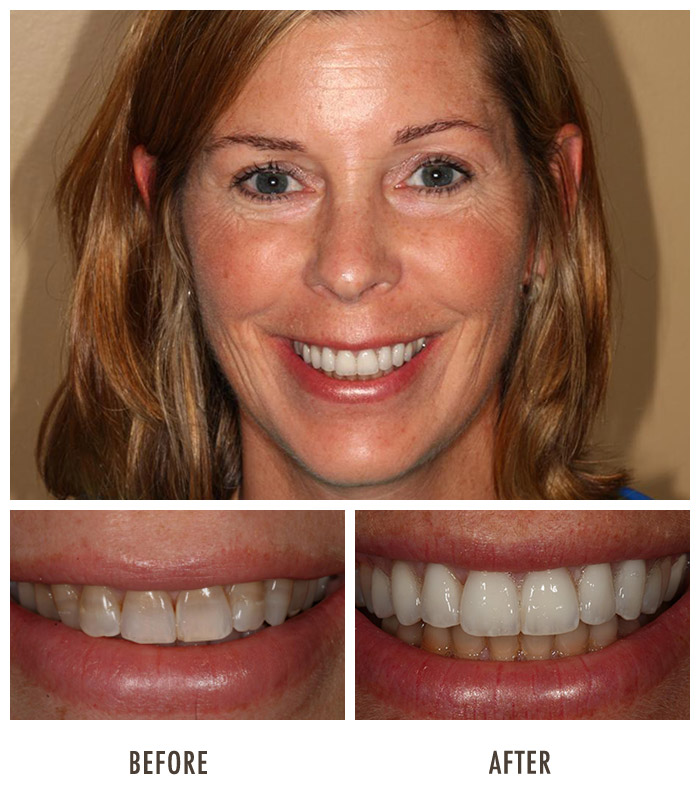 tooth-bonding-porcelain-veneers-chicago