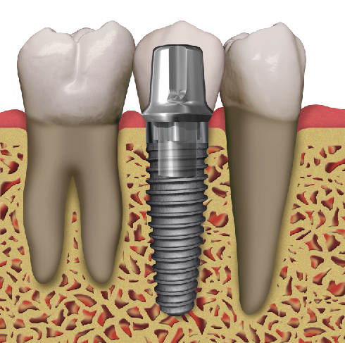 dental implant failures in chicago