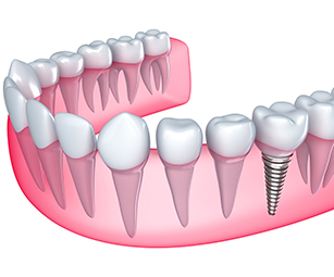 dental-implants-elmhurst