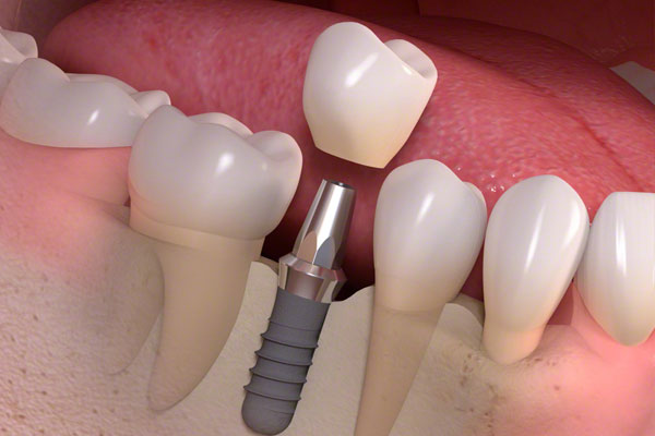 teeth implants
