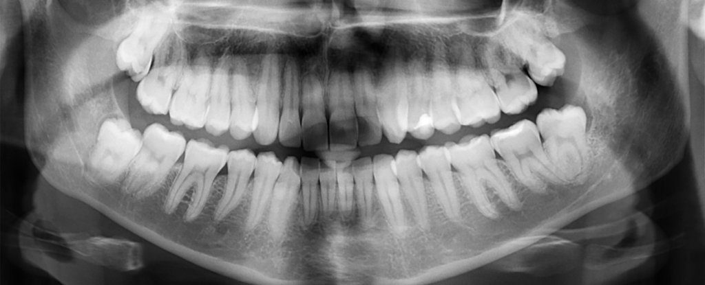 dental cavities