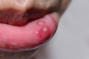 common mouth sores