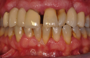 periodontal disease 