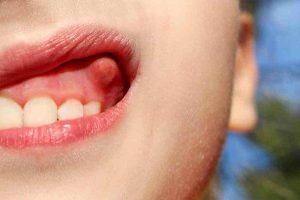 risk of oral cancer growth